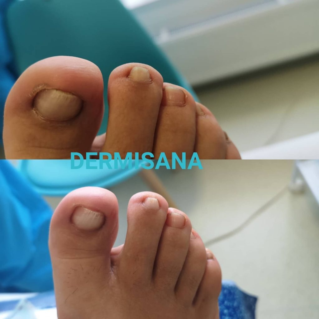 Onicomicoza - infectia fungica a unghiei